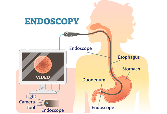 endoscopic procedure illustration.png endoscopic procedure illustration.png