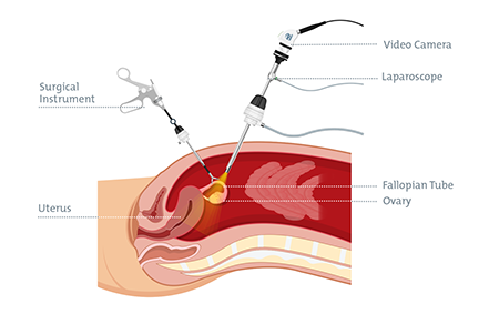 laparoscopy-for-endometriosis-diagram.png laparoscopy-for-endometriosis-diagram.png